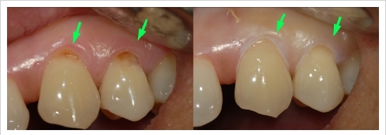 cervical restoration